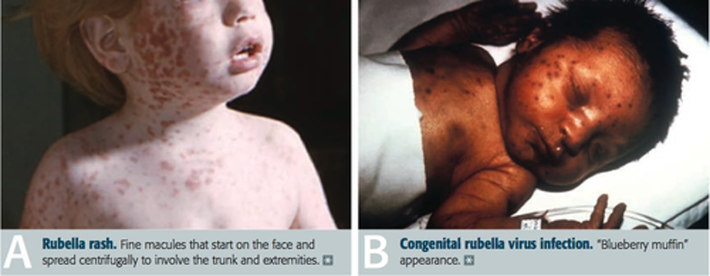 <p>Mild fever, malaise, followed by maculopapular skin rash (face → body), milder than measles, resolves in 3 days</p>