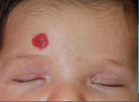 <p><strong>Infantile Hemangioma</strong></p><p>-More common in _________; increased incidence in low birth weight or preterm infants&nbsp;</p><p>-Present at birth or develop within the first few weeks of life&nbsp;</p><p>-May initially appear as pale ______ macule with ____________ proliferating to a bright red, lobulated ________/nodule&nbsp;</p><p>-Superficial → reach max size by __-__ months&nbsp;</p><p>-Deep → may grow for ___-___ months&nbsp;</p><p>-Most spontaneously resolve over __-___ years&nbsp;</p><p>-Risks → __________, bleeding, amblyopia or pressure on globe if periorbital, may accompany other malformations&nbsp;</p><ul><li><p>If subglottic, airway _________ can occur. Subglottic hemangiomas are also associated with<strong> Beard hemangiomas</strong></p></li></ul><p>-If treatment needed, you can try oral or topical _____ _________ or pulsed dye laser treatment&nbsp;</p><p></p>