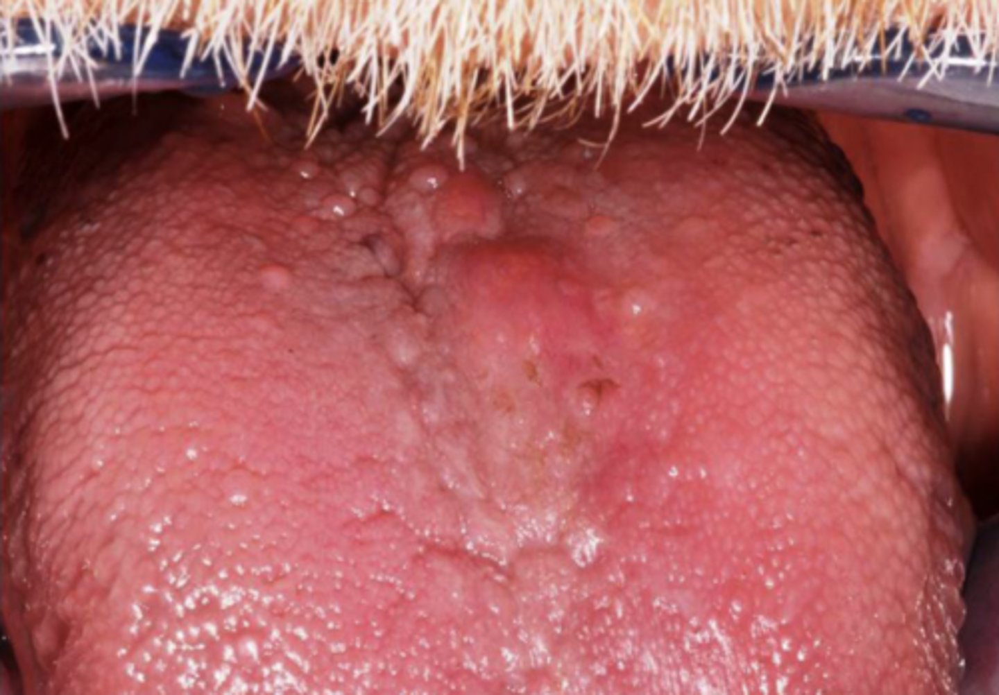 <p>amyloid nodule - solitary, asymptomatic submucosal deposit</p>