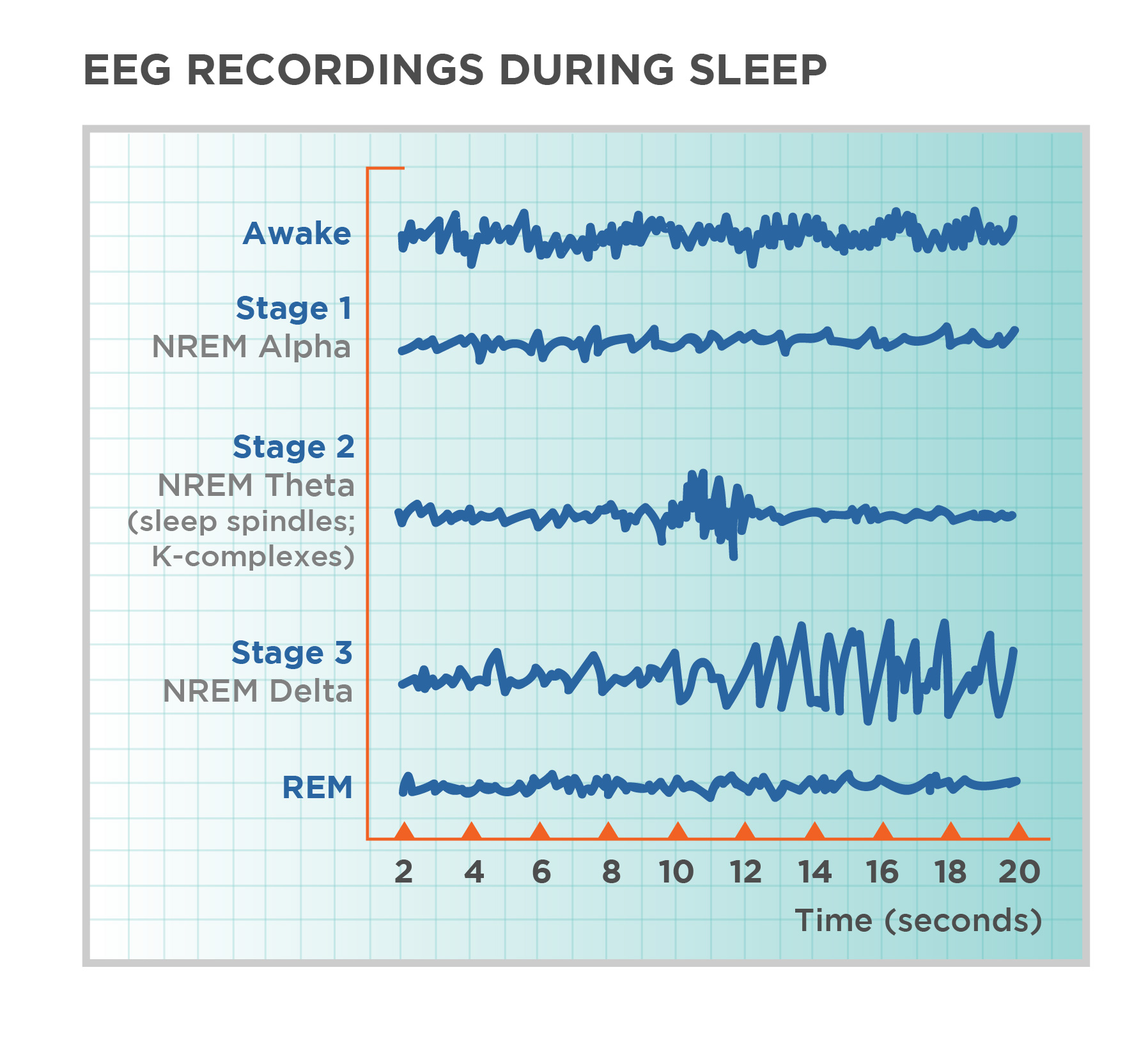 <p>EEG → measures electrical activity in the brain </p><ul><li><p>Macroelectrodes attached to the scalp to record summed population-level activity of millions of neurons</p></li><li><p>Can be used a diagnostic tool since specific patterns of EEG activity are associated with different states of consciousness (awareness), subconsciousness (sleep stages), and cerebral atrophy (neural loss)</p></li></ul><p></p>