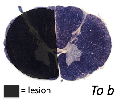 <p>hemisection of the spinal cord resulting in paralysis and loss of proprioception on the ipsilateral side as the injury or lesion, and loss of pain and temperature sensation on the contralateral side as the lesion</p>