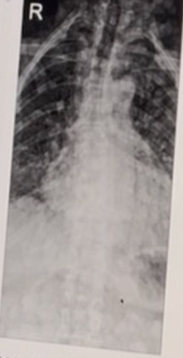 <p>Adult patient with known chronic condition. The patient also demonstrates multiple smooth margin, non-elevated darkly pigmented skin lesions on their thorax.</p><p>Most likely diagnosis?</p>