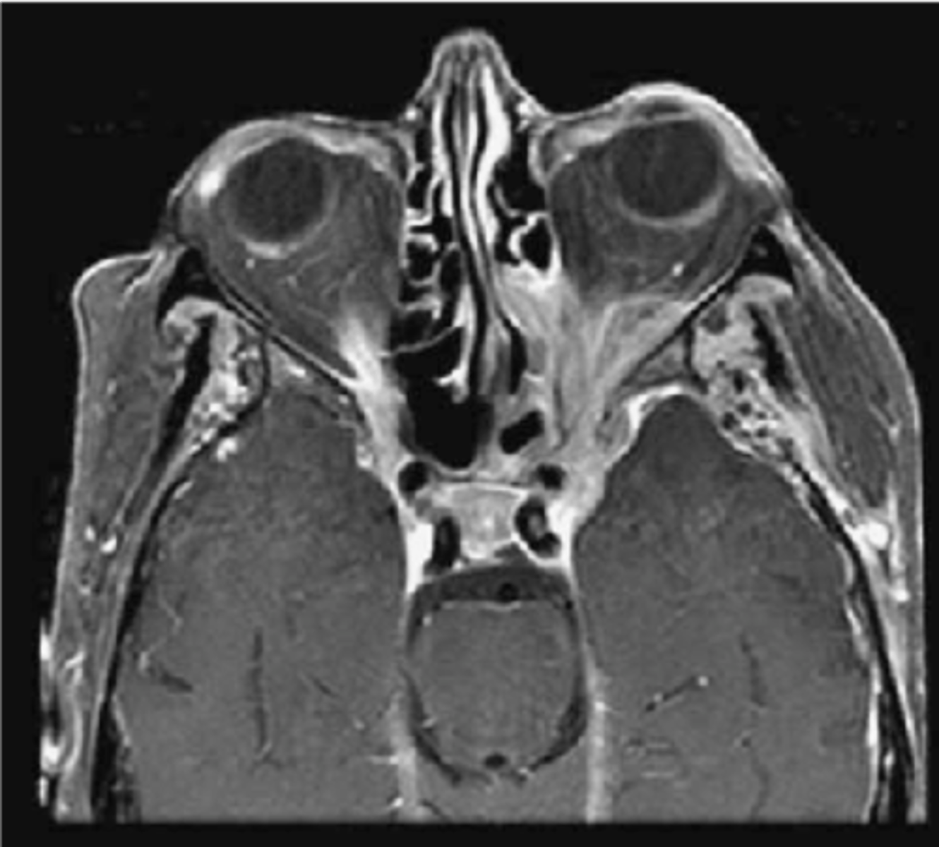 <p>expanding lesions at the orbital apex</p>