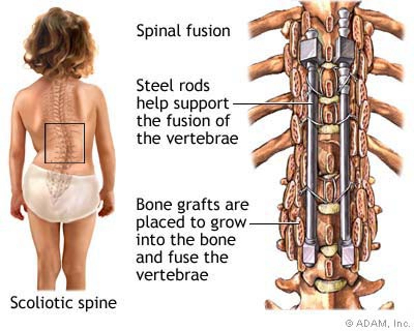 <p>for curve more than 60 degrees</p><p>- you lose mobility with a rod</p>