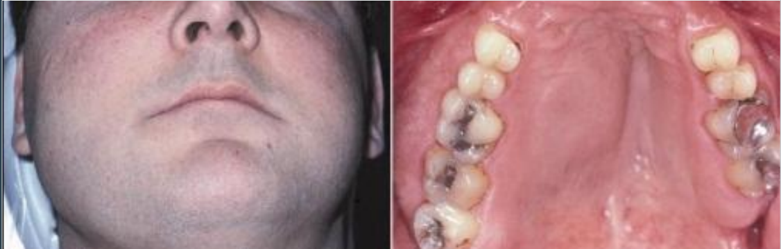 <p>painless, slowly growing swelling of the affected area </p>