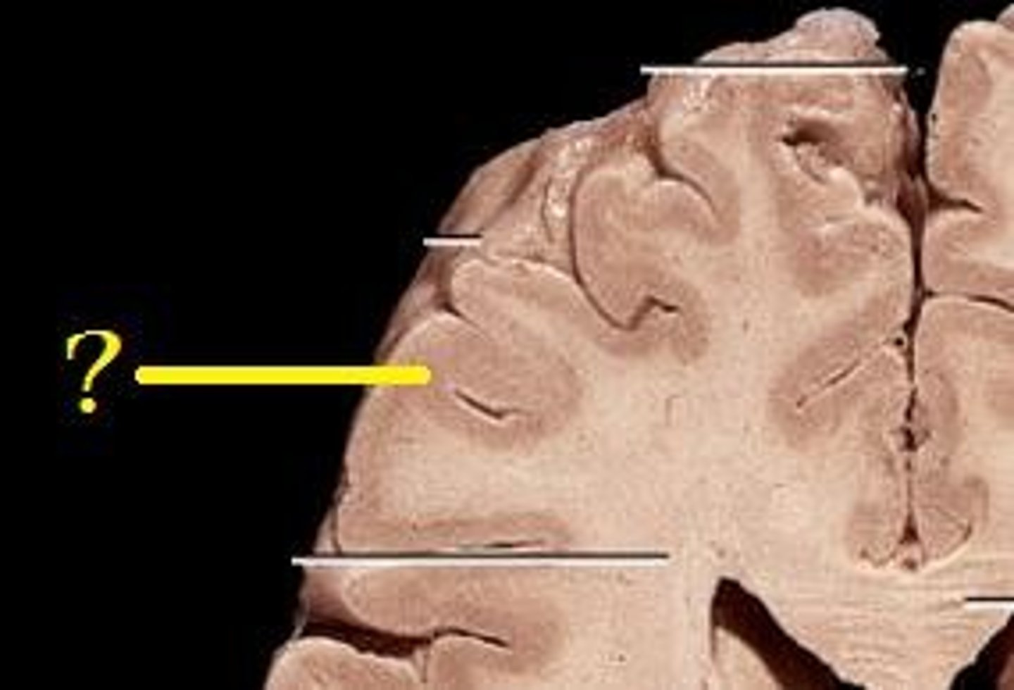 <p>areas of the brain that are dominated by cell bodies and are devoid of myelin. Mostly receives and processes information</p>