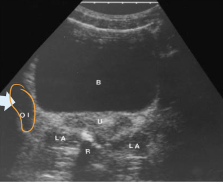 <ul><li><p>hypoechoic elongated, vertical, ovoid structure</p></li></ul><p></p>