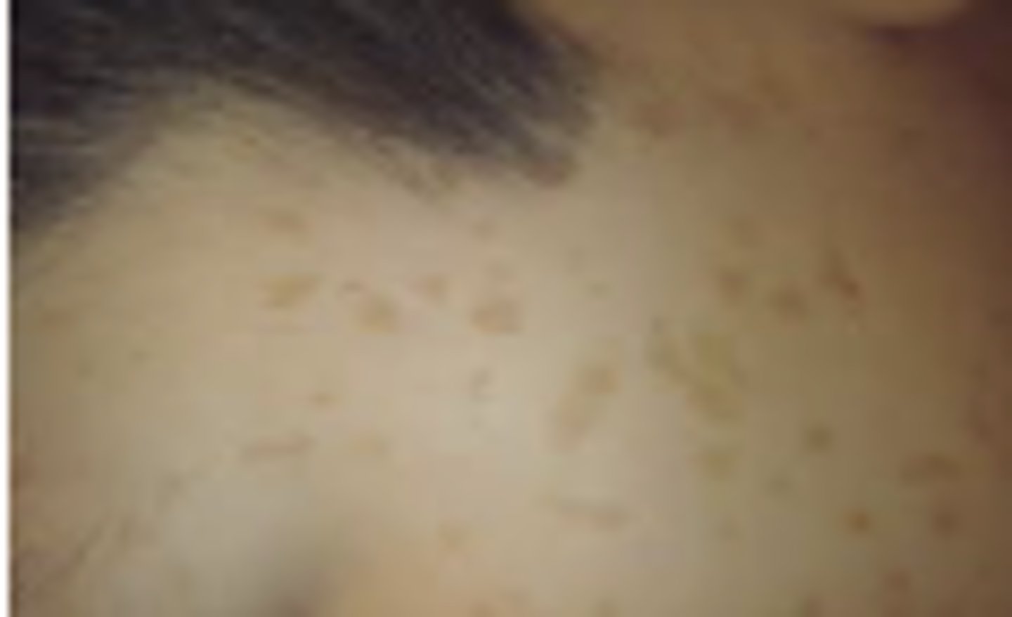 <p>A flat, distinct, discolored area of the skin that is not elevated; usually less than 1 cm in size. Examples: Freckles and certain birthmarks.</p>