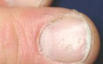<p>Punctate depression of nail plate by defective layering by proximal nail matrix</p>