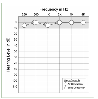 <p>normal, conductive, senso?</p>