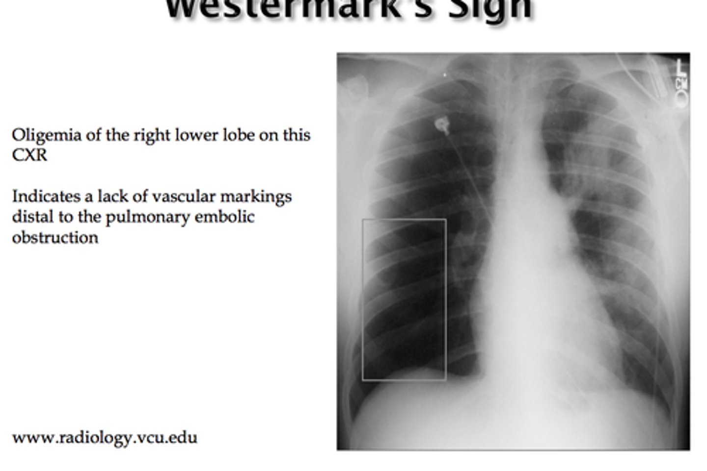 <p>Westermark sign</p>