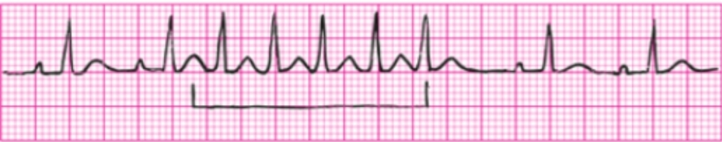 <p>HR 160-250, interrupted rhythm has different heartrate, atrial tach is regular but causes strip to appear regular but interrupted, uniform P waves different from sinus, normal PR and QRS ints</p>