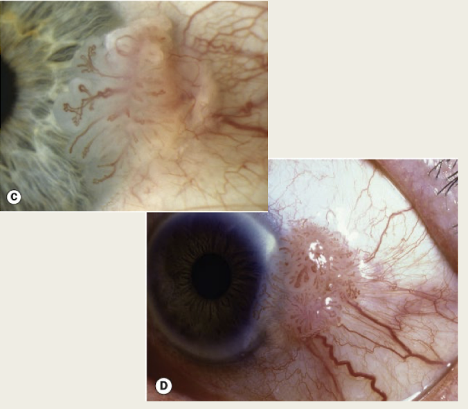 <p>fleshy, gelatinous mass (looks like sessile papilloma)</p><p>enlarged feeder vessels</p>