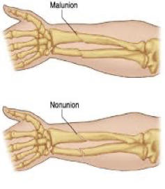 <p>the bone fragments are not healing together</p><p>no replacement of lost bone - gap persists</p>