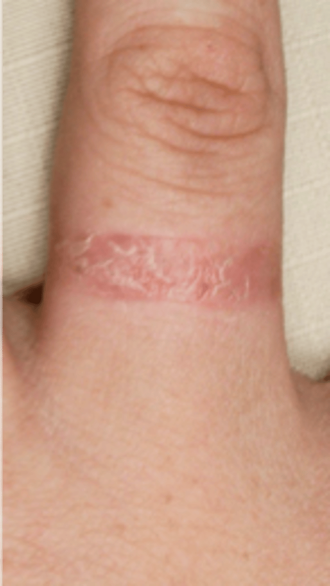 <p>name the skin pathology</p>
