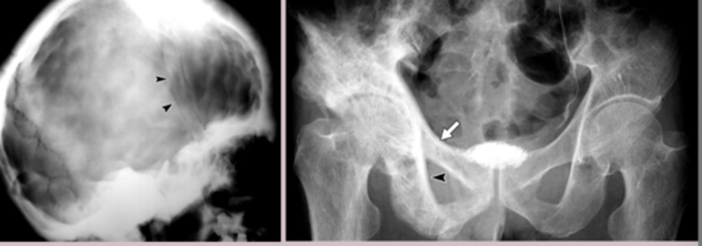 <p>Labs</p><p>-alkaline phosphatase = elevated </p><p>-calcium, phosphate, PTH = normal </p><p>Imaging </p><p>-often incidental finding </p><p>-Xray: lytic lesions, slcerotic lesions, bone enlargement and deformity </p><p>-bone scan: increased uptake in affected bone </p><p>-bone biopsy: mosaic pattern </p>
