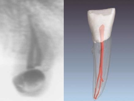 <p><strong>Maxillary</strong> - 2 roots</p><p class="has-focus"><strong>Mandibular </strong>- more than one canal and root</p>