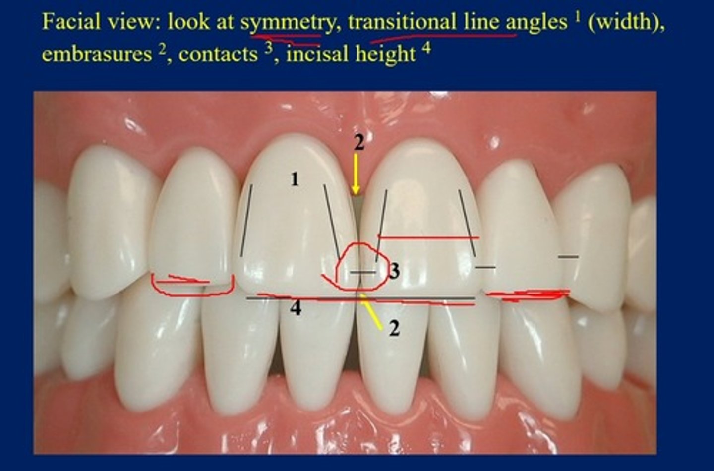 <p>symmetry, transitional line angles ( width), contacts, incisal height</p>