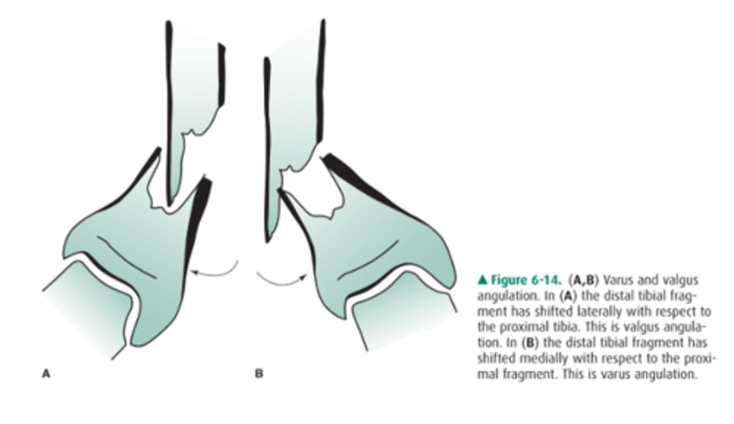 <p>Use direction and degree:</p><p>EX: "30 degrees of varus angulation of the distal fragment"</p>