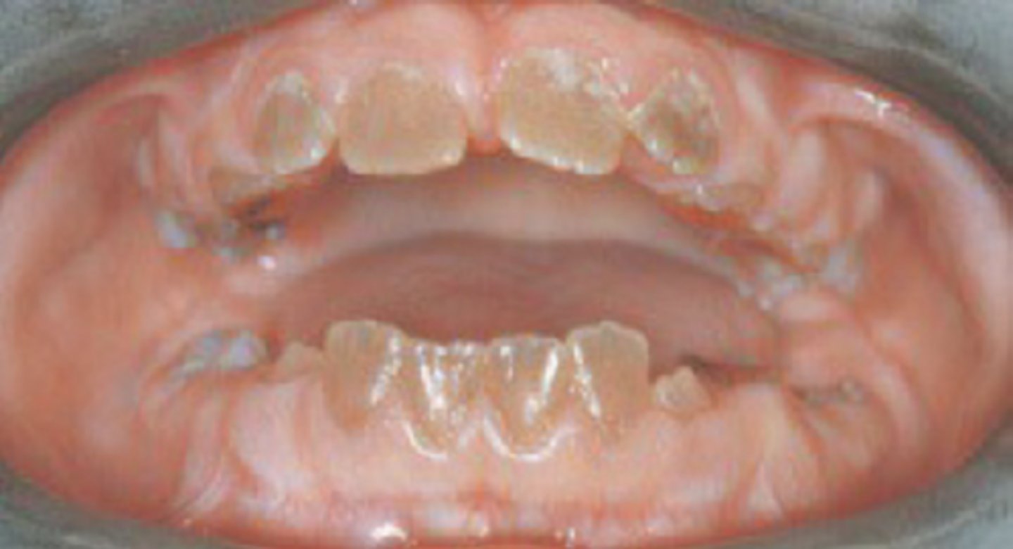 <p>dentinogenesis imperfecta</p>