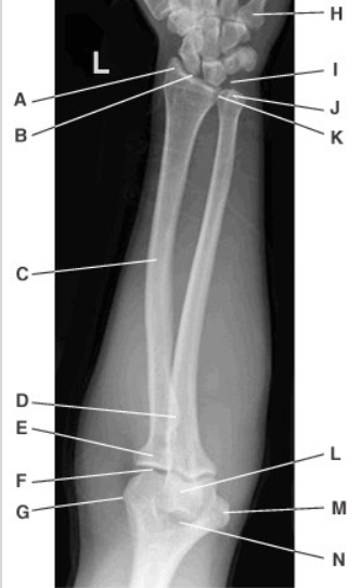 <p>In this AP Forearm and Elbow projection, what is indicated by label H? </p>
