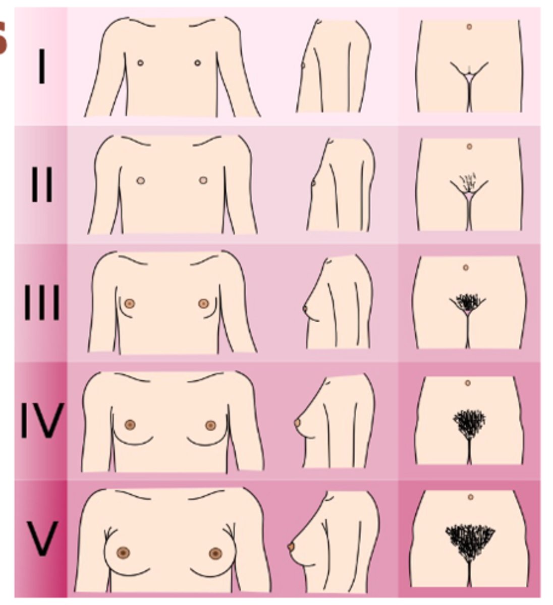 <p>-stage 1: no glandular tissue, elevated nipple only, no pubic hair </p><p>-stage 2: breast buds forms, small area of surrounding glandular tissue, sparse growth of long, downy hair labia </p><p>-stage 3: breasts and areola enlarge but no contour separation, darker, coarser and more curled hair, spreading sparsely over pubic symphysis </p><p>-stage 4: areolar and nipple form secondary mound above breast tissue, adult type but less in distribution so spread to medial thigh</p><p>-stage 5: mature contour, with nipple projecting and areolar recessed into general breast contour, adult distribution in quantity and type, spread to medial thigh </p>