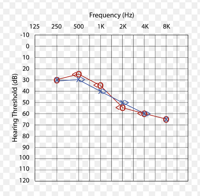 <ul><li><p>both air & bone conduction thresholds elevated </p></li><li><p>no significant air-bone gap </p></li><li><p>often shows sloping configuration </p></li><li><p>(indicates cochlear or auditory nerve damage) </p></li></ul><p></p>