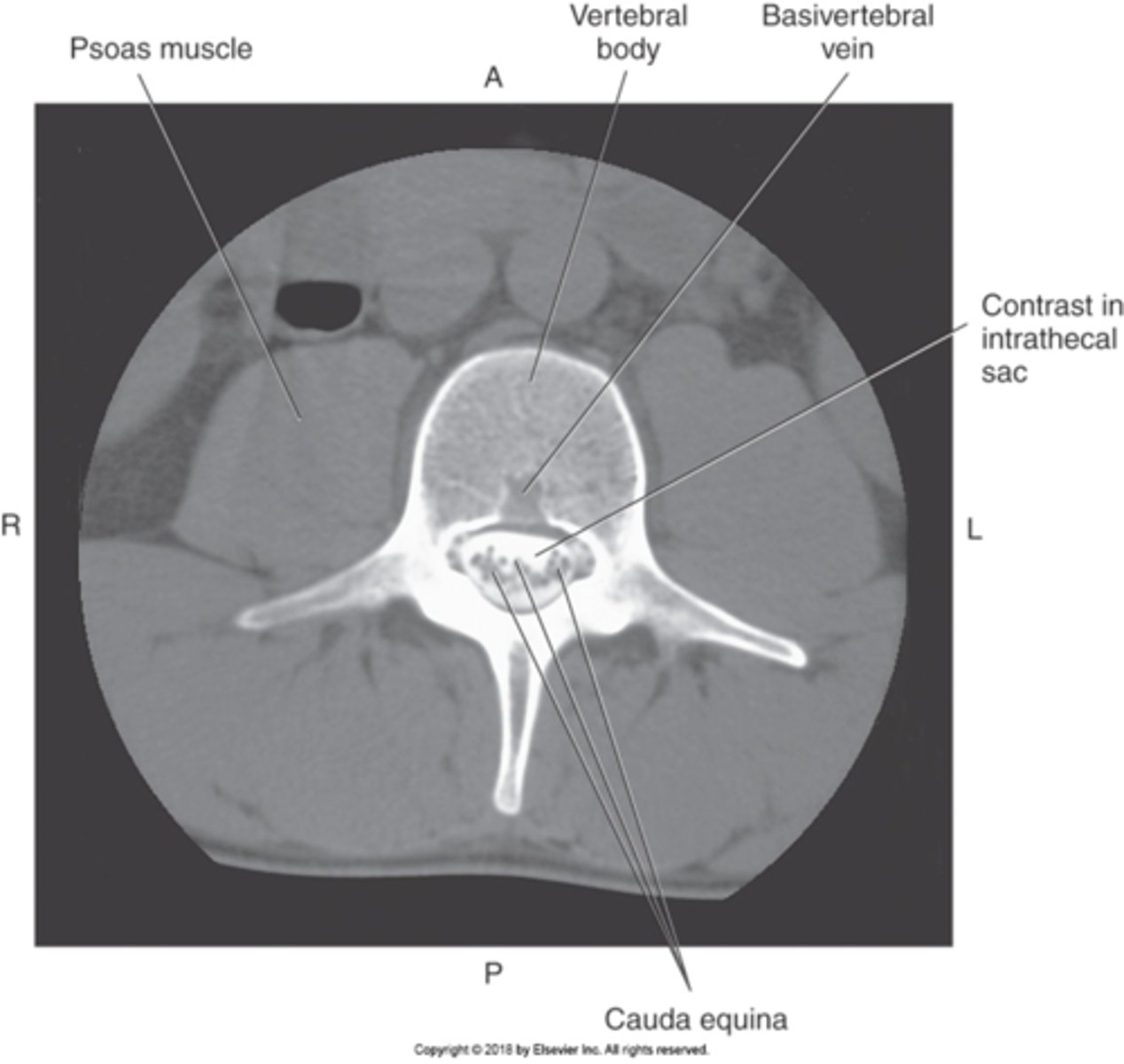 <p>What artifact on this image is present</p>