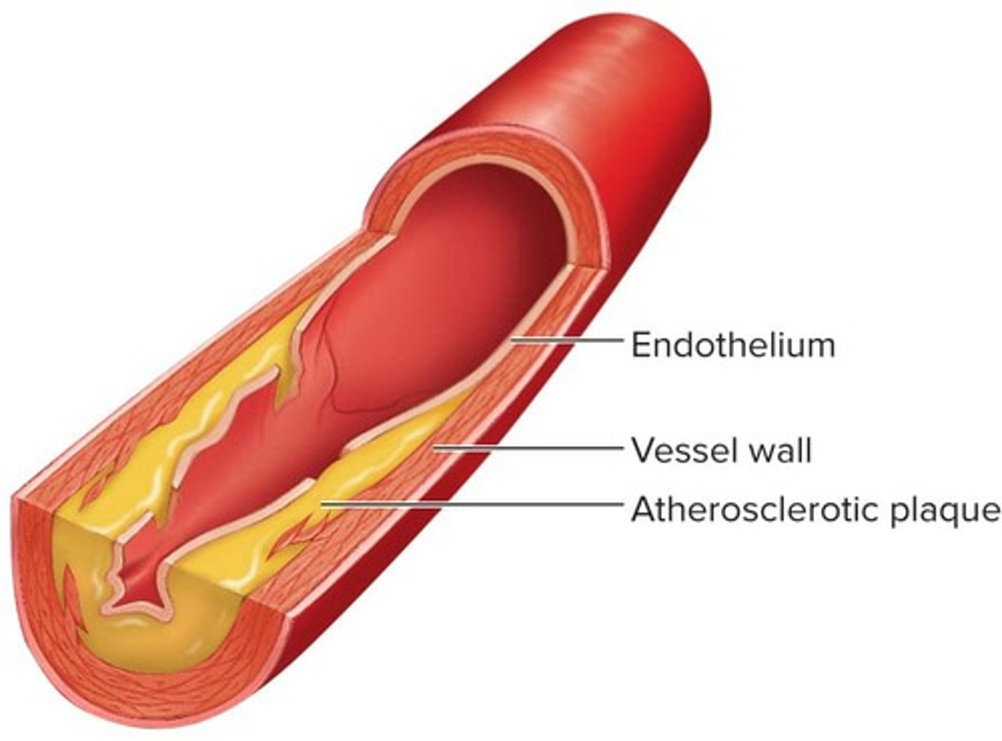 <p>Deposition of plaque on the walls of medium and larger arteries, including coronary arteries.</p>