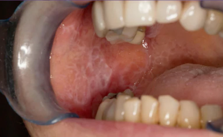 <p>patient is asymptomatic, what is the management?</p>