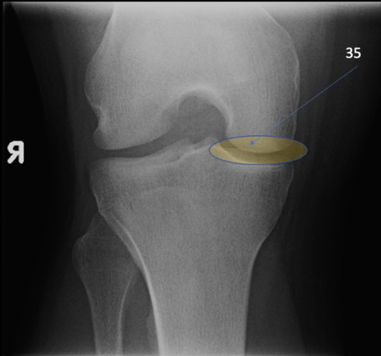 <p>ID 35 (joint)</p>