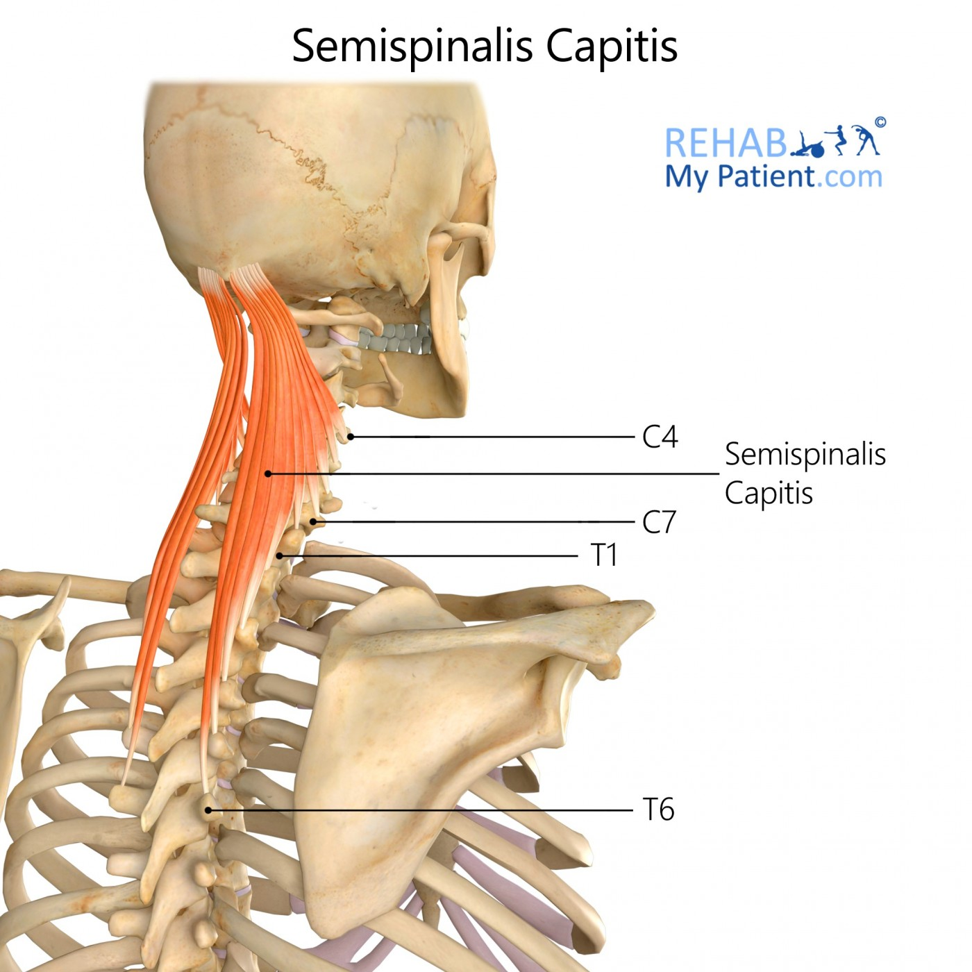 <p>O: Transverse process of T1-T6 &amp; Articular process of C4-C7</p><p>I: Occipital bone between nuchal lines</p><p>A: B/l- Extend neck, 1- Extends neck, laterally flexes &amp; rotates neck to opposite side</p>