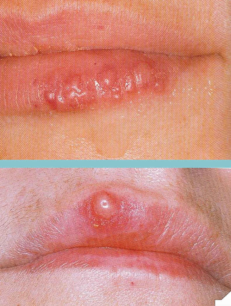 <p>Herpes labialis </p>