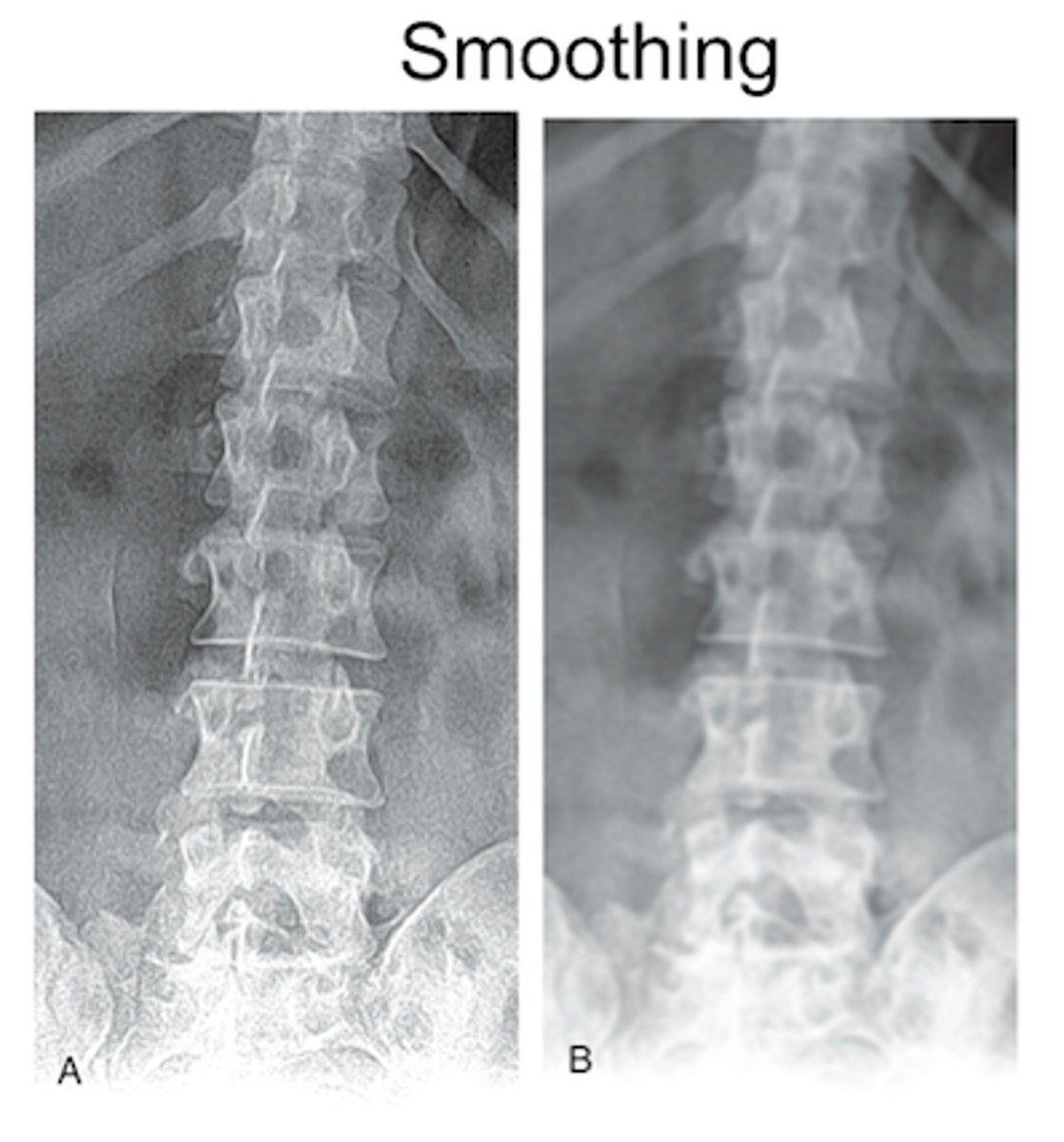 <p>Post-processing technique that suppresses visible mottle in an image, reduces noise, and makes edges appear less harsh</p><p>Should not be used with severe quantum mottle</p>