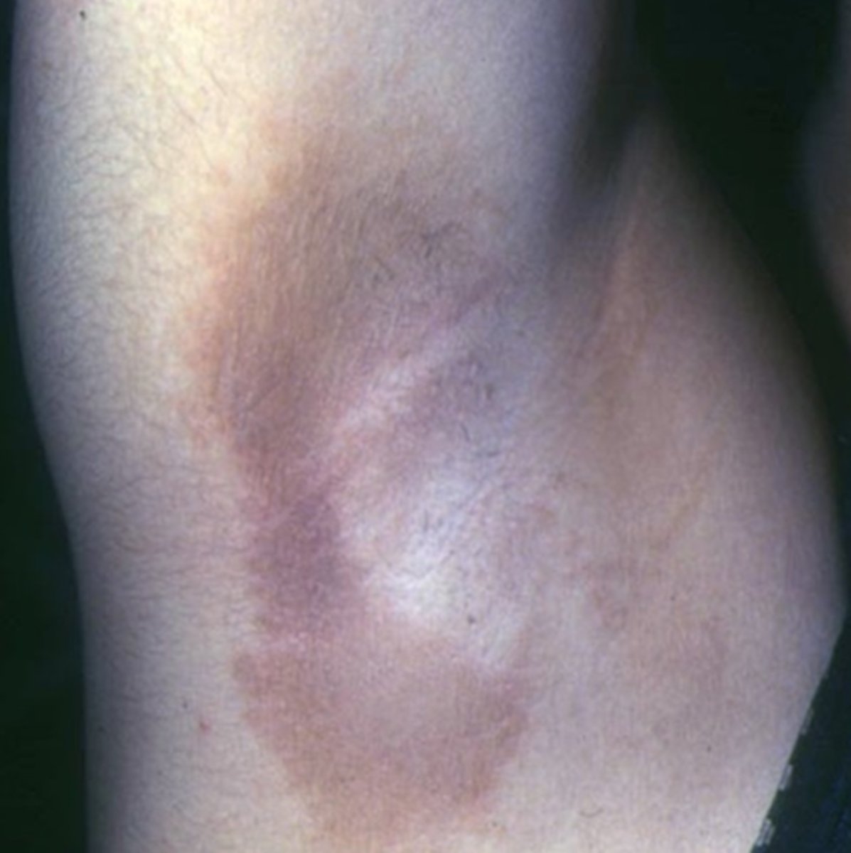 <p>What are the main features of <strong>Alstrom syndrome</strong>?</p>