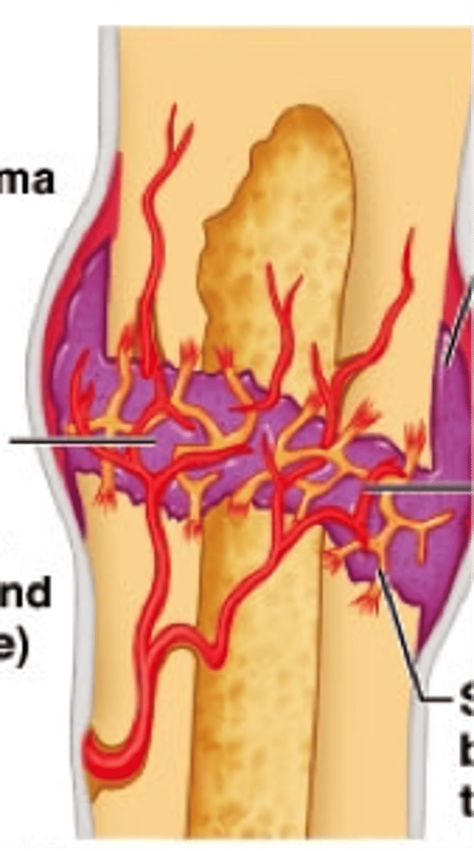 <p>2nd step in healing a broken bone:</p><p>connective tissue forms scaffolding to close the gap</p>