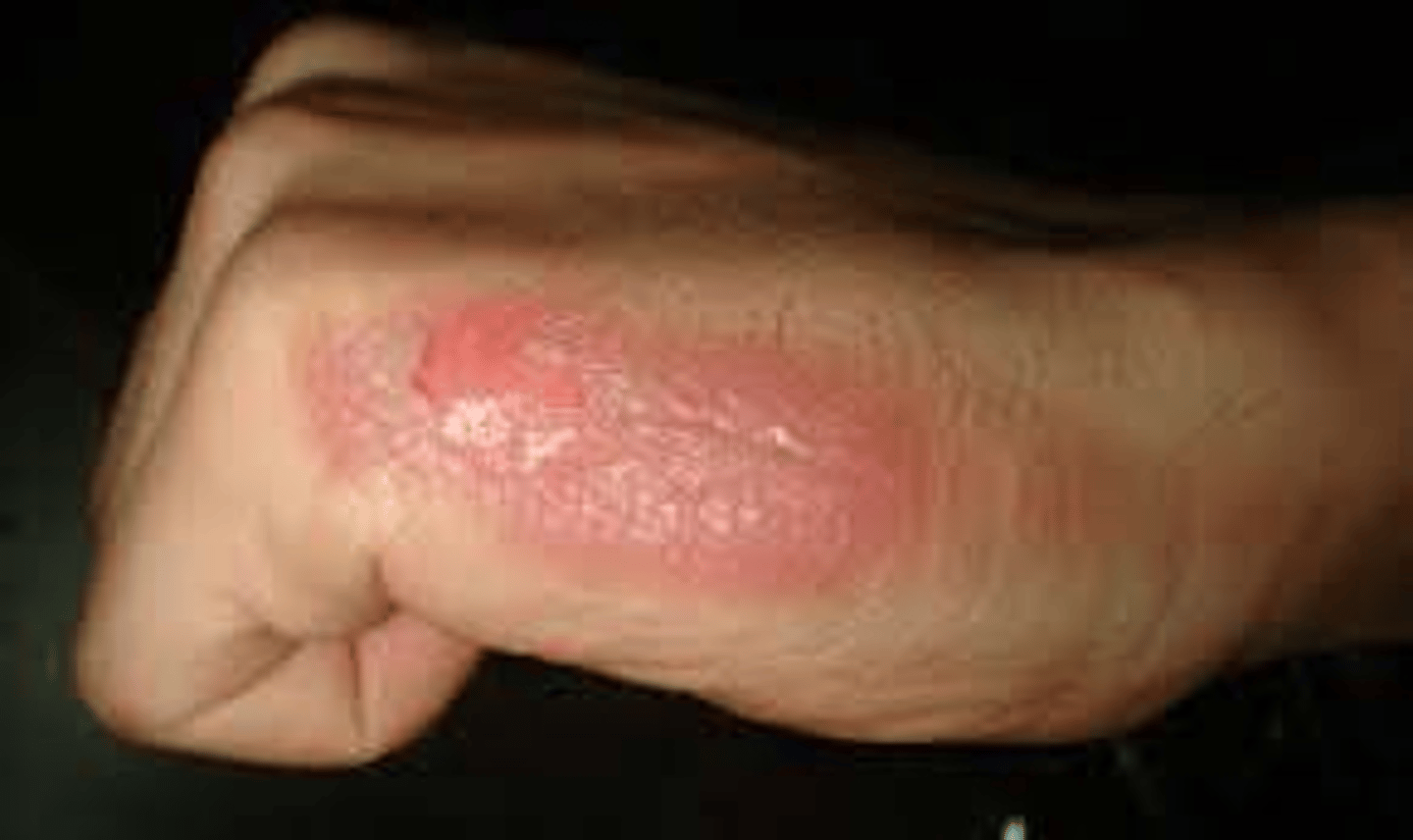 <p>Only epidermis affected; Redness and pain; No blisters or swelling occurs</p>
