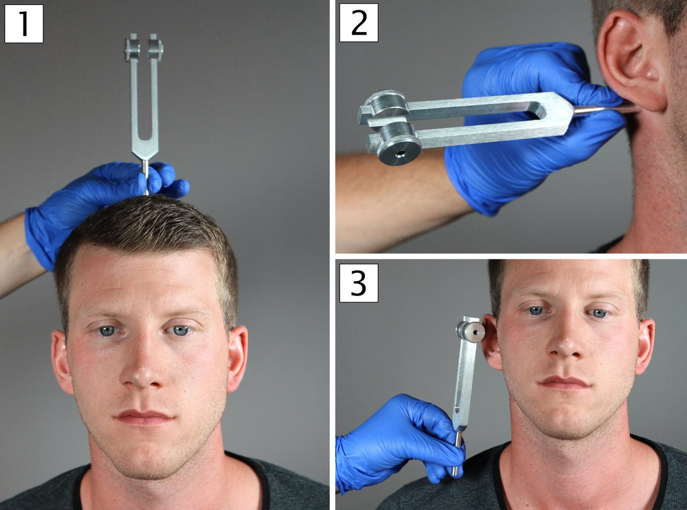 <p>A. Sensorineural hearing loss on the left</p>