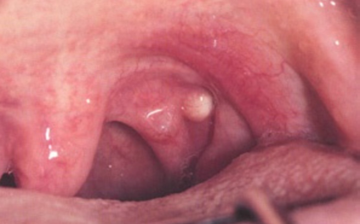 <p>Oral Lymphoepithelial Cyst </p><p>**KNOW FOR EXAM</p>