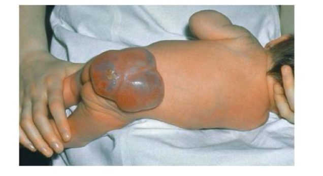 <p>A portion of the spinal cord protrudes itself through the back </p>