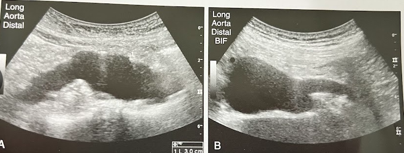 <p>A 55 year old man w/Hx of cigarette smoking undergoes sonography of the Ao b/c of a pulsatile mass over the area of the umbilicus on physical examination. The distal Ao is shown. What is the most likely diagnosis? </p>