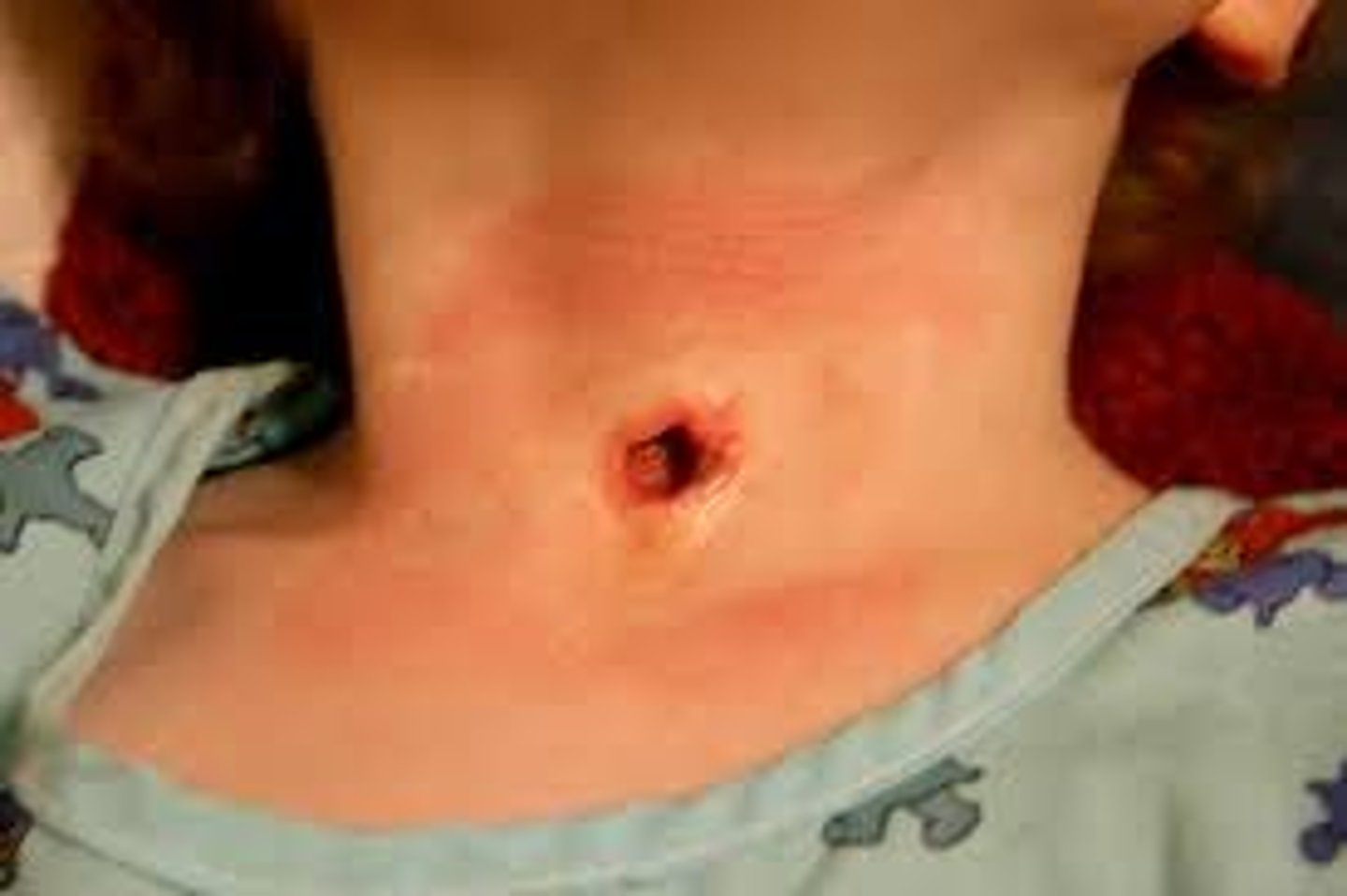 <p>surgical opening into the trachea</p>