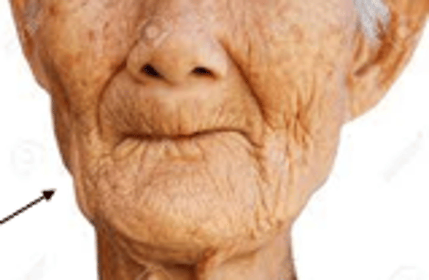 <p>- Decreased salivary secretions and loss of taste</p><p>- Teeth may wear down or fall out due to periodontal disease</p><p>- Without teeth, lower portion of face looks small and sunken, with accentuated "purse-string" wrinkles radiating from mouth </p><p>- Angular cheilitis</p><p>- Cervical lymph nodes become less palpable but, submandibular glands become easier to feel</p>