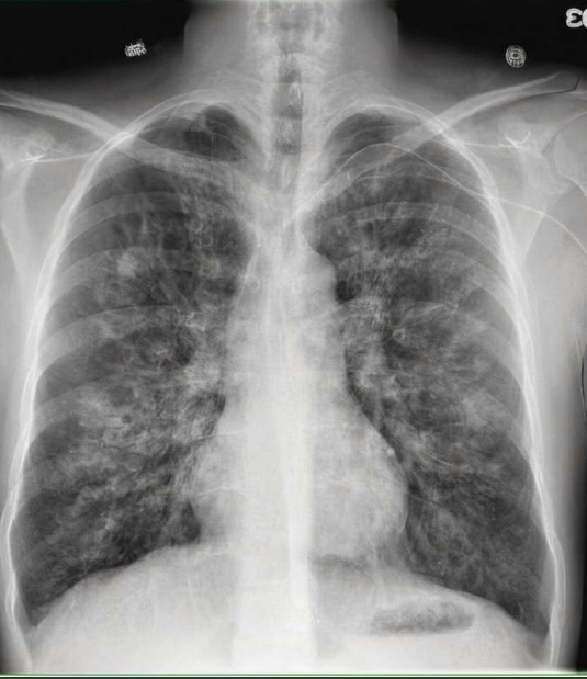 <p>What pathology is seen on this x-ray?</p>