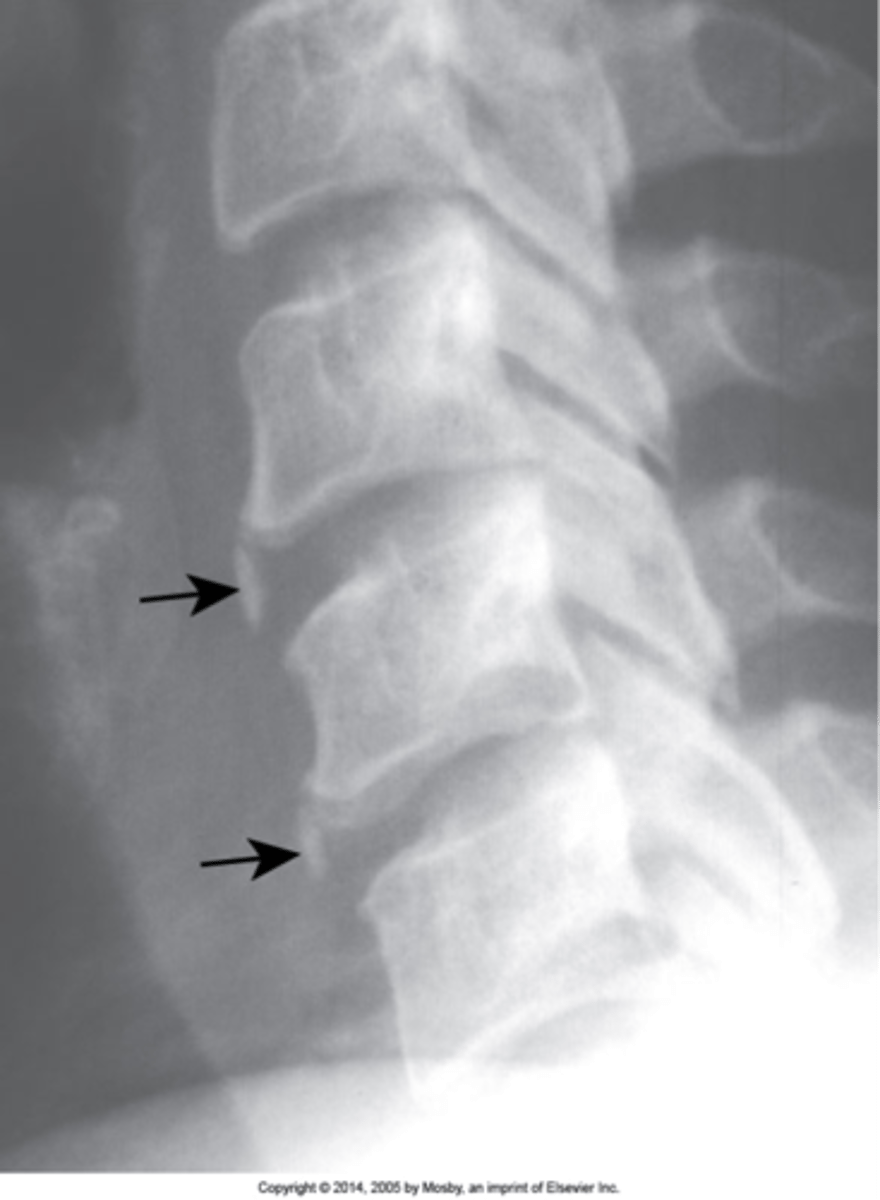 <p>Calcification of the annulus fibrosis, commonly dystrophic calcification (post-traumatic alterations, which attracts calcium)</p>
