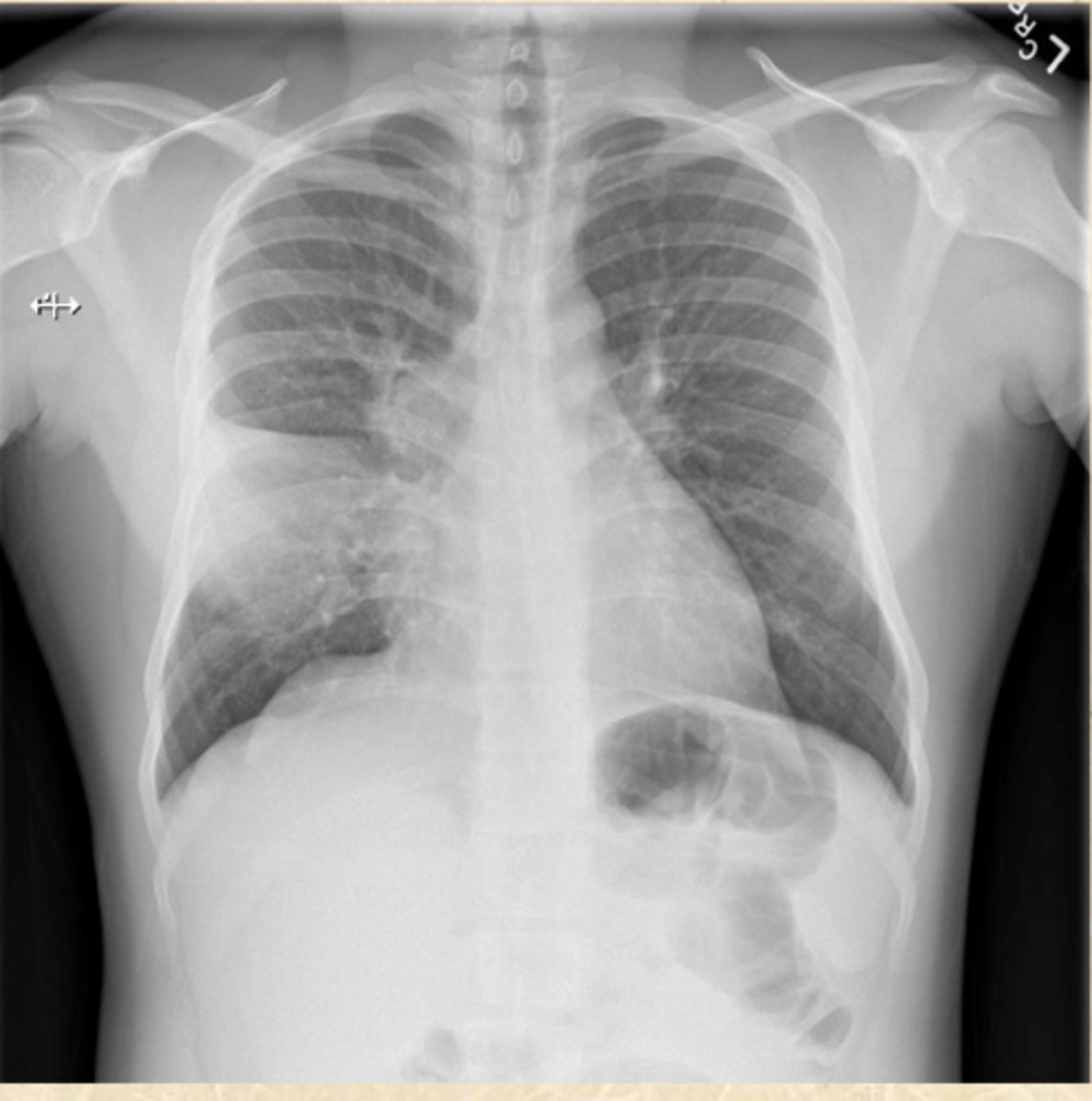 <p>What does this CXR show?</p>