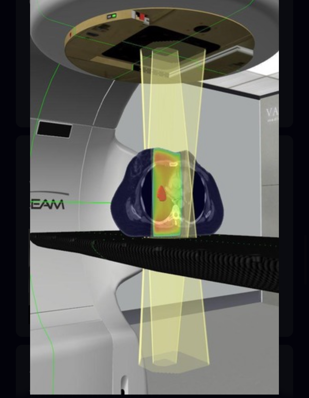 <p>additional field used in conjunction w/ tangents and sclav to enhance dose to the axillary region</p>