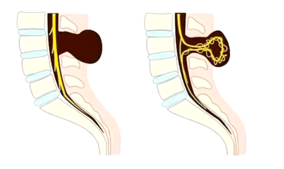 <p><strong>• If the failure occurs at the vertebral column = Protrusion of spinal cord and meninges through an opening in the vertebrae (spina bifida or rachischisis).</strong></p><p>• Meningocele: protrusion of meninges, covered by skin through the vertebrae. Associated to accumulation of CSF.</p><p>• Meningomyelocele: as above but also contains spinal cord parenchyma in the protrusion.</p>