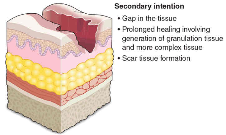 <p>Abundant granulation and fibrotic tissue formation</p><ul><li><p>To replace and restore structure of tissue</p></li></ul><p>Regeneration takes longer; <strong>needs new tissue</strong></p><ul><li><p>Myofibroblasts</p><ul><li><p>CT cells that cause contraction</p></li></ul></li><li><p>Increased risk for scarring</p></li></ul><p>Highly susceptible to</p><ul><li><p>Infection</p></li><li><p>Complications</p></li><li><p>Deformity</p></li></ul><p></p><p>NOTE:</p><ul><li><p>Regeneration of same cells to replace lost tissue is NOT possible</p></li></ul><p></p>