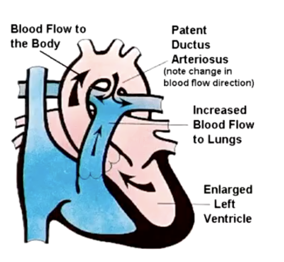 <p>Patent ductus arteriosus: pressure gradient between aorta and pulmonary artery persists in both systole and diastole</p><p>(heard throughout cardiac cycle)</p>